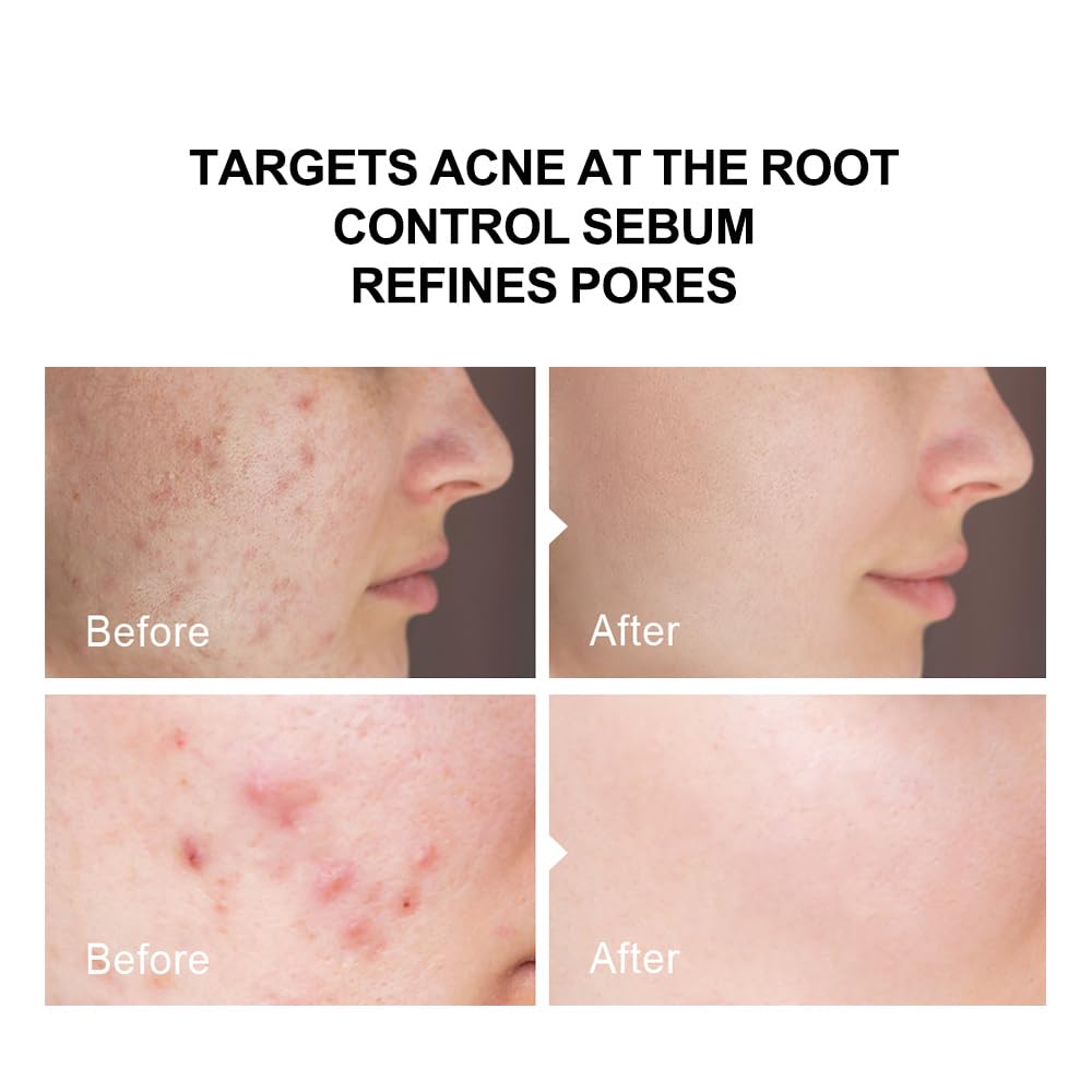 2% Salicylic Acid (Bha) Serum For Acne & Blackheads - Unclogs Pores, Oil Control, Sensitive-Skin Safe, Fragrance-Free,1 Fl.Oz