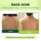 2% Salicylic Acid (Bha) Serum For Acne & Blackheads - Unclogs Pores, Oil Control, Sensitive-Skin Safe, Fragrance-Free,1 Fl.Oz