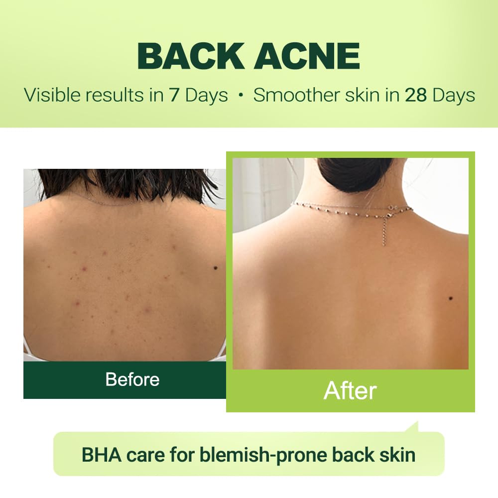2% Salicylic Acid (Bha) Serum For Acne & Blackheads - Unclogs Pores, Oil Control, Sensitive-Skin Safe, Fragrance-Free,1 Fl.Oz