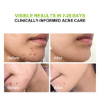 2% Salicylic Acid (Bha) Serum For Acne & Blackheads - Unclogs Pores, Oil Control, Sensitive-Skin Safe, Fragrance-Free,1 Fl.Oz