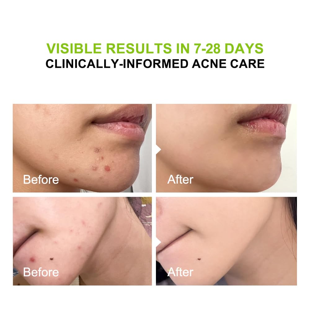 2% Salicylic Acid (Bha) Serum For Acne & Blackheads - Unclogs Pores, Oil Control, Sensitive-Skin Safe, Fragrance-Free,1 Fl.Oz
