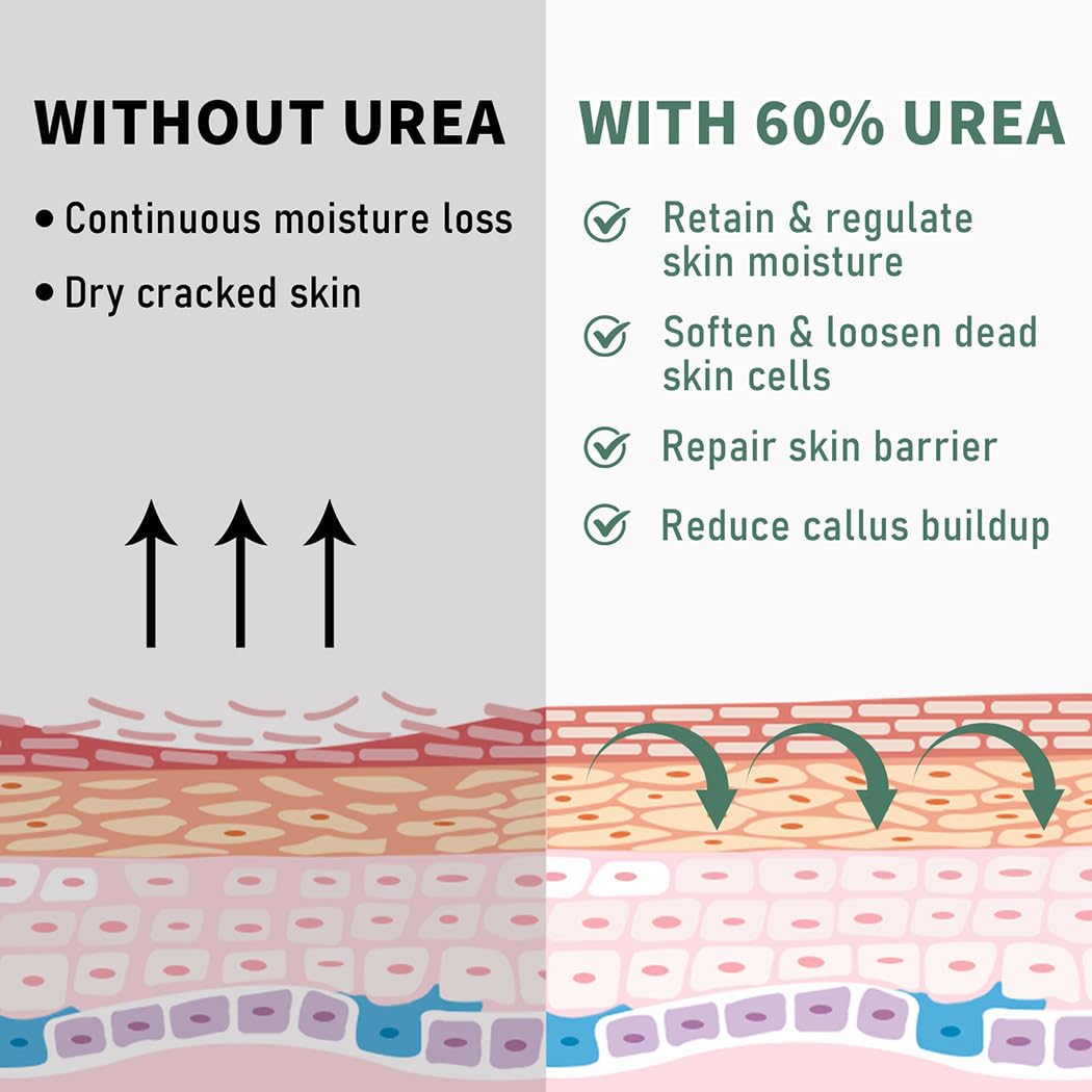 60% Urea Cream Maximum Strength, 10.1 oz - Foot & Hand Cream for Dry Cracked Skin, Callus Remover, with 2% Salicylic Acid - Deep Moisturizer for Cracked Heels, Rough Elbows & Knees - Fast Absorbing