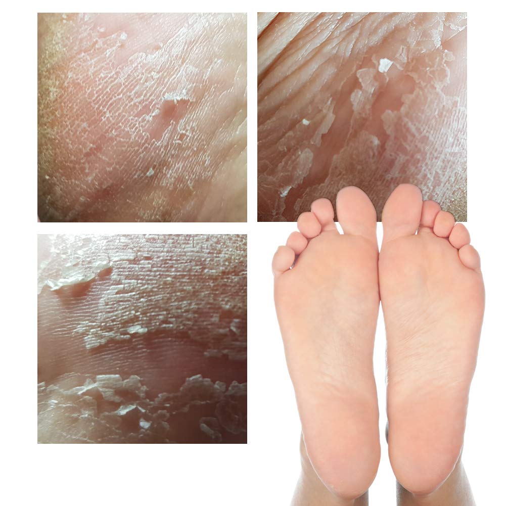 Elizavecca/Foot Peel /1 Foot Pack 2 Pairs Foot Mask - Boots for Exfoliating/foot pack review/foot pack before and after