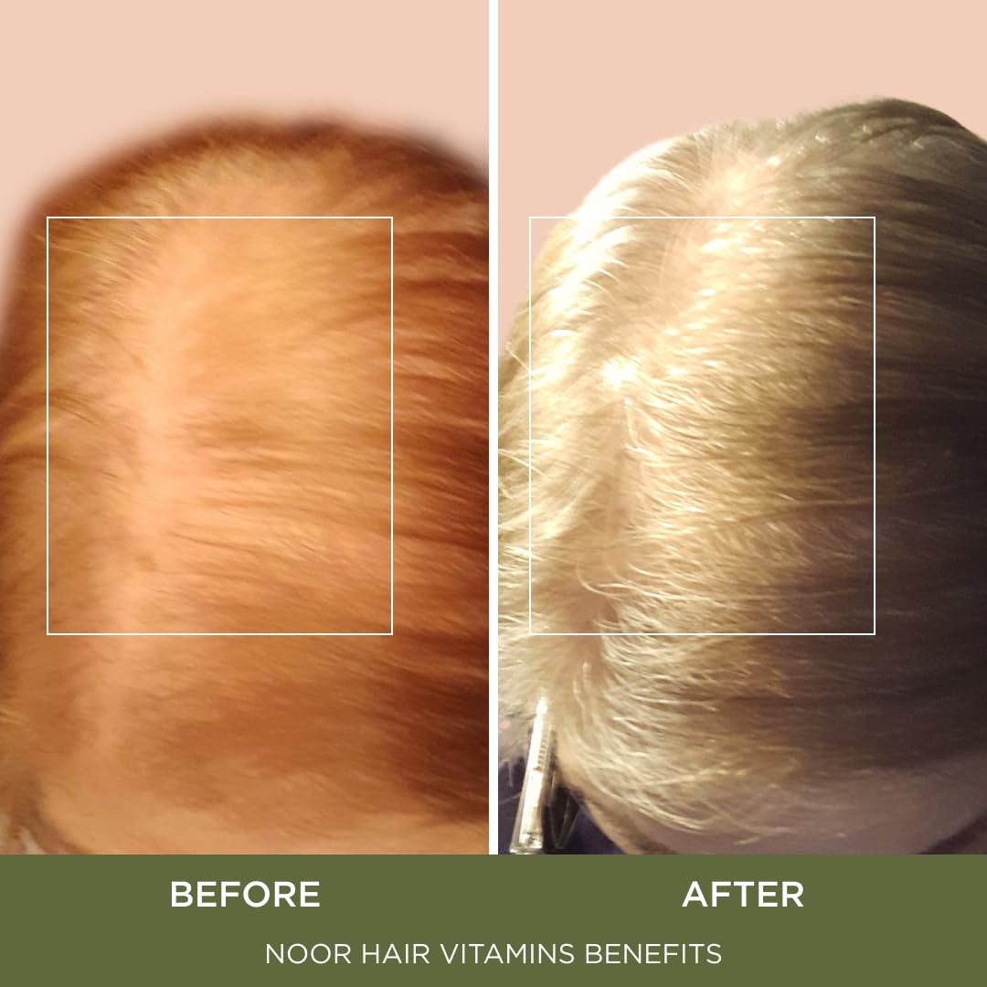 Noor Hair Healthy Hair Formula, Hair Growth Supplement Supporting Thick Hair And Fast Hair Regrowth. Vitamin C, B6, Zinc, Propietary Non-Gmo & Gluten Free Womens Hair Loss Vitamins - 30 Day Supply