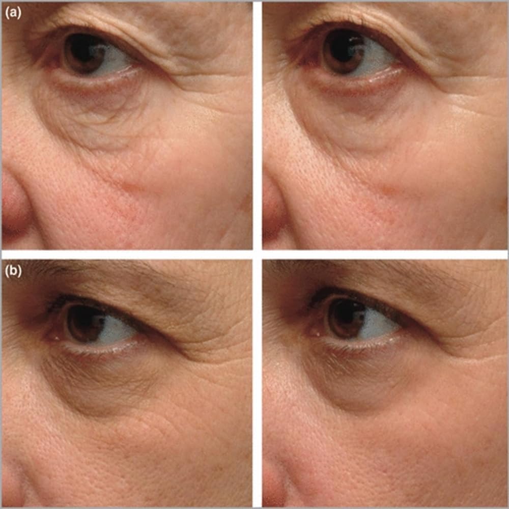 Instant Firming Eye Serum Anti-Aging Formula For Under Bags And Wrinkles Cream Wrinkle Filler Visibly Improves Dark Circles Treatment Puffines (3, 0.49 Fl Oz)