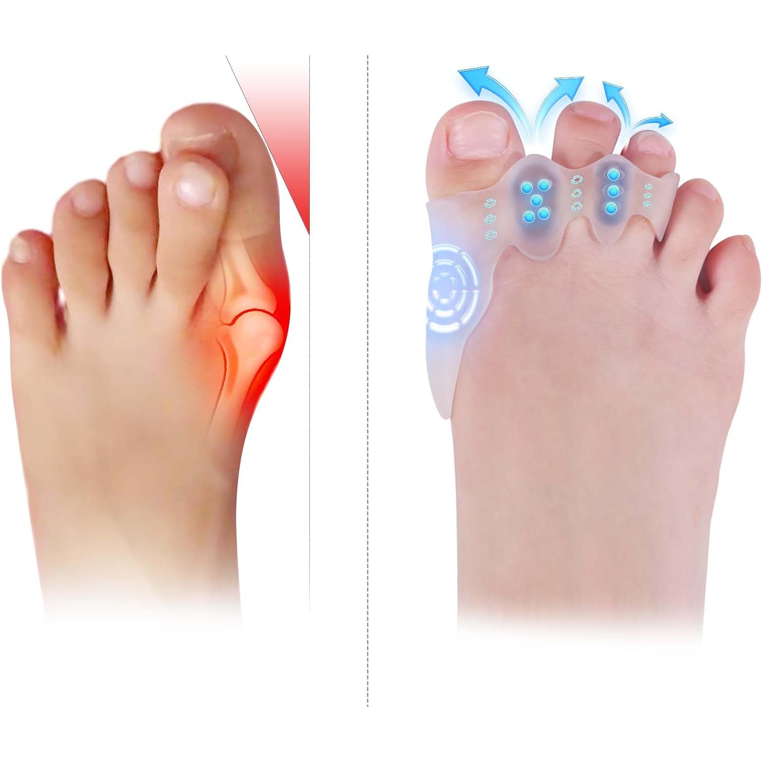 Toe Spacers & Bunion Corrector for KidsMenWomen|Corn Callus Removers|Bunion Relief|Overlapping Toes Separators (Toe Corrector Set (1 Pair, 20 ct Fillers), Small-Kids)