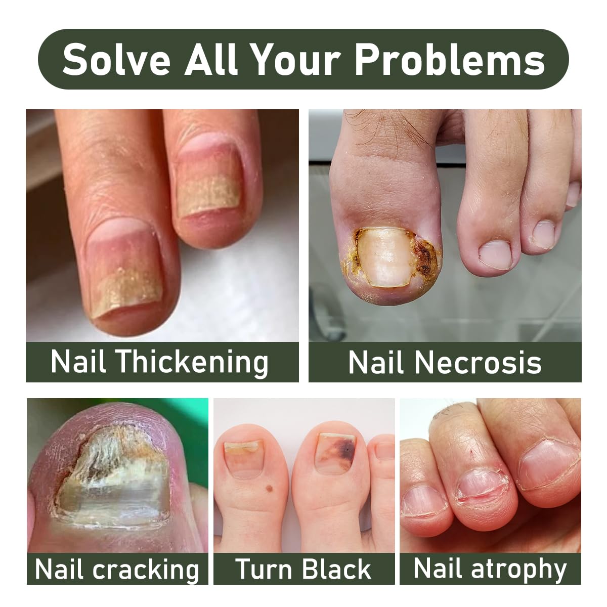 2PCS Ginger Nail Serum Solution, Ginger Cuticle Care Oil for Nails