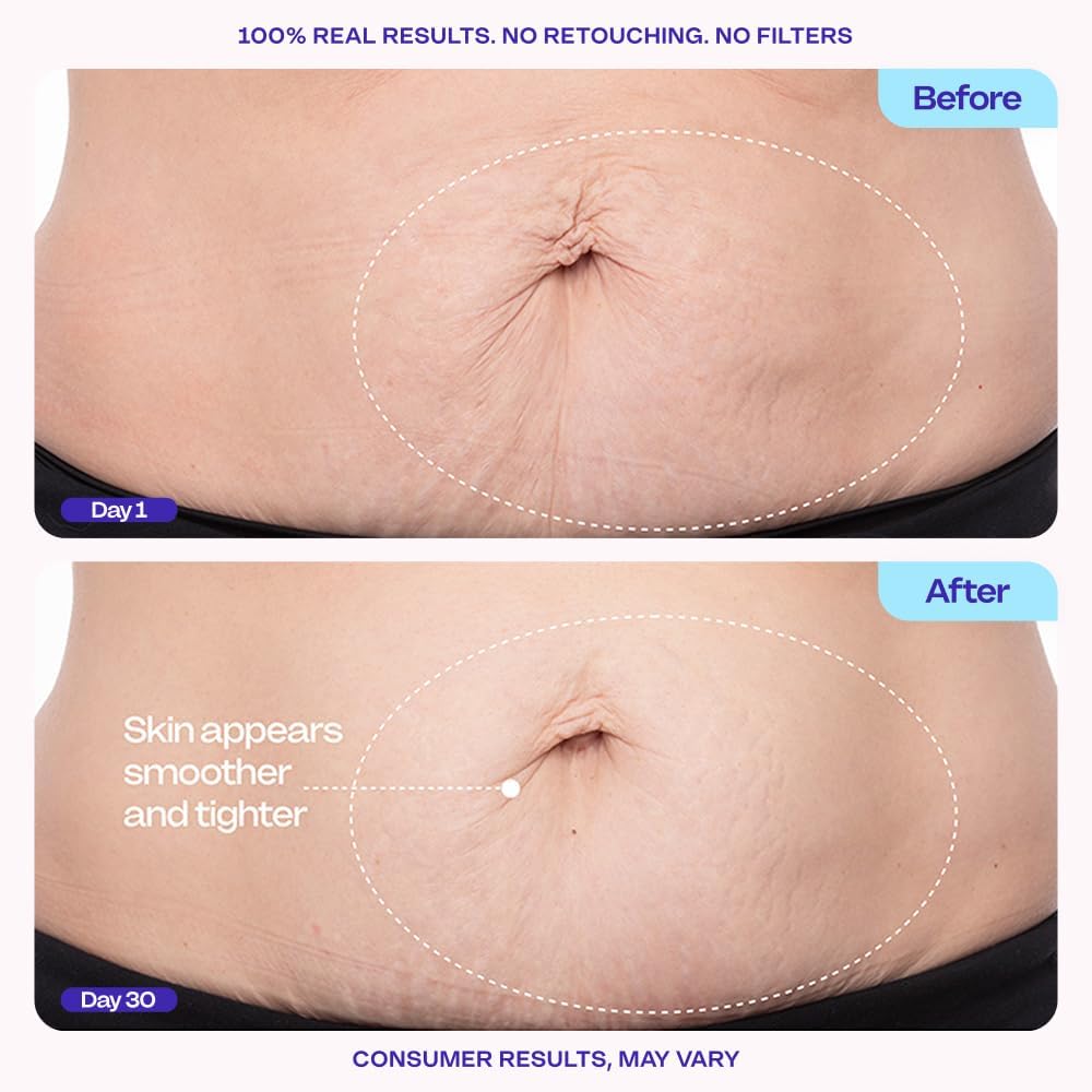 Gopure Tighten & Smooth Belly Cream - Clinically Tested With Microtight4 Complex To Reduce The Appearance Of Cellulite & Stretch Marks - Quick Absorbing For Smoother, Firmer-Looking Skin, 4.25Oz