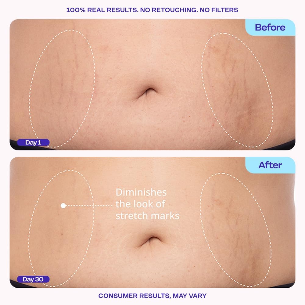Gopure Tighten & Smooth Belly Cream - Clinically Tested With Microtight4 Complex To Reduce The Appearance Of Cellulite & Stretch Marks - Quick Absorbing For Smoother, Firmer-Looking Skin, 4.25Oz