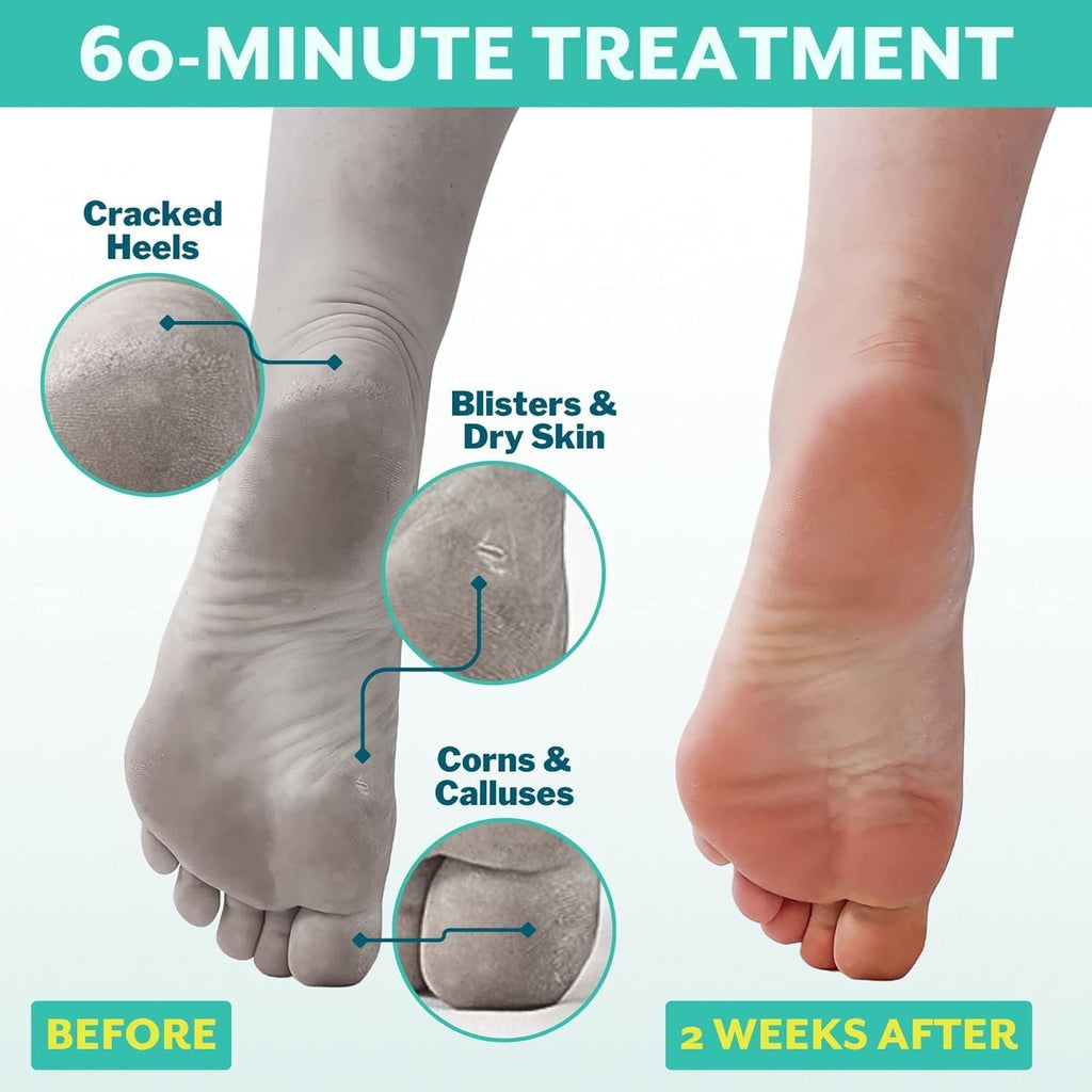 Patchology PoshPeel Pedi Cure - Foot Peel Mask Soak Treatment, Feet Peeling Mask, Pedicure Booties with Deep Exfoliation for Baby-soft Skin, Pedicure Supplies for Foot Care, 1 Pair
