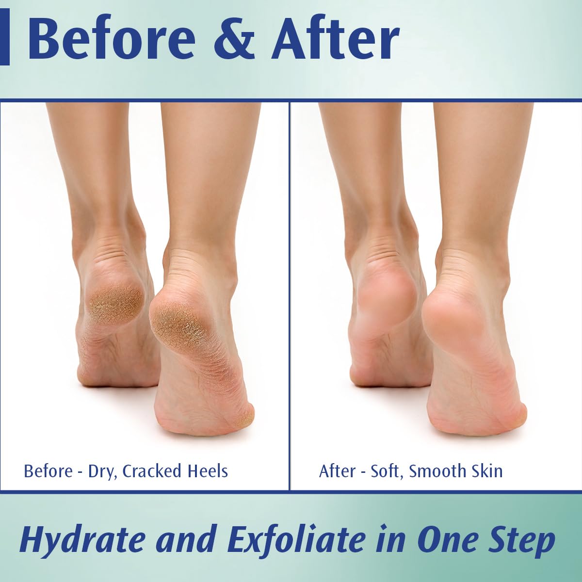 Pedifix Podiatrists' Choice 20% Urea Callus Control Extra Strength Foot Cream 4 Oz. (113g) - Professional Treatment for Dry, Cracked Feet, Callus & Foot Care Relief