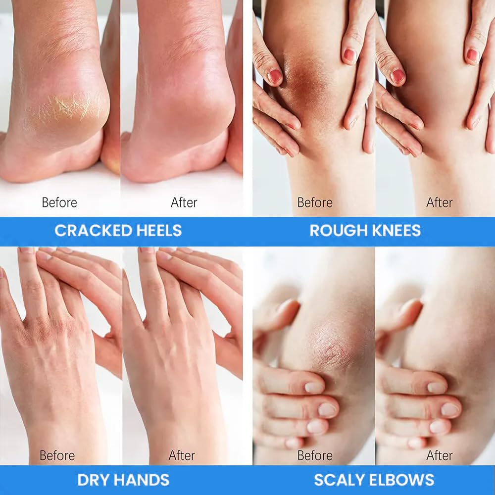 Urea Cream with 2% Salicylic Acid Foot Cream for Dry Cracked Heels, Heel Care Cream 5.29 Oz (Pack of 1)