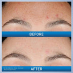 Cerave Resurfacing Retinol Serum For Post Acne Marks, Formulated With Licorice Root Extract & Niacinamide, Brightening Serum & Pore Minimizer For Face, Post Acne Skin Barrier Repair, Non-Comedogenic
