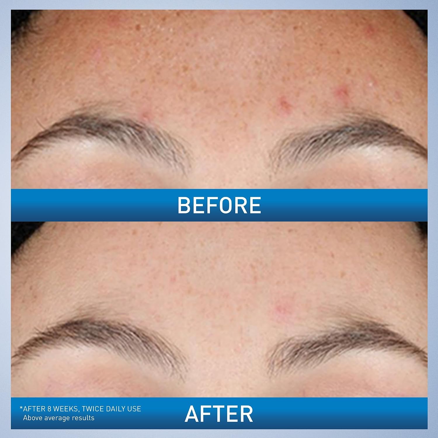 Cerave Resurfacing Retinol Serum For Post Acne Marks, Formulated With Licorice Root Extract & Niacinamide, Brightening Serum & Pore Minimizer For Face, Post Acne Skin Barrier Repair, Non-Comedogenic