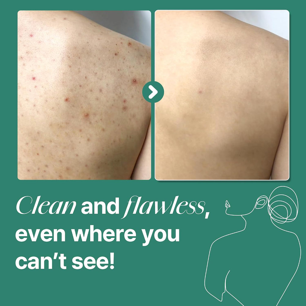 Some By Mi Aha Bha Pha 30 Days Miracle Acne Clear Body Cleanser 13.5Oz – Salicylic Acid & Tea Tree Acne Body Wash – Deep Cleansing, Sulfate & Paraben Free Korean Skin Care
