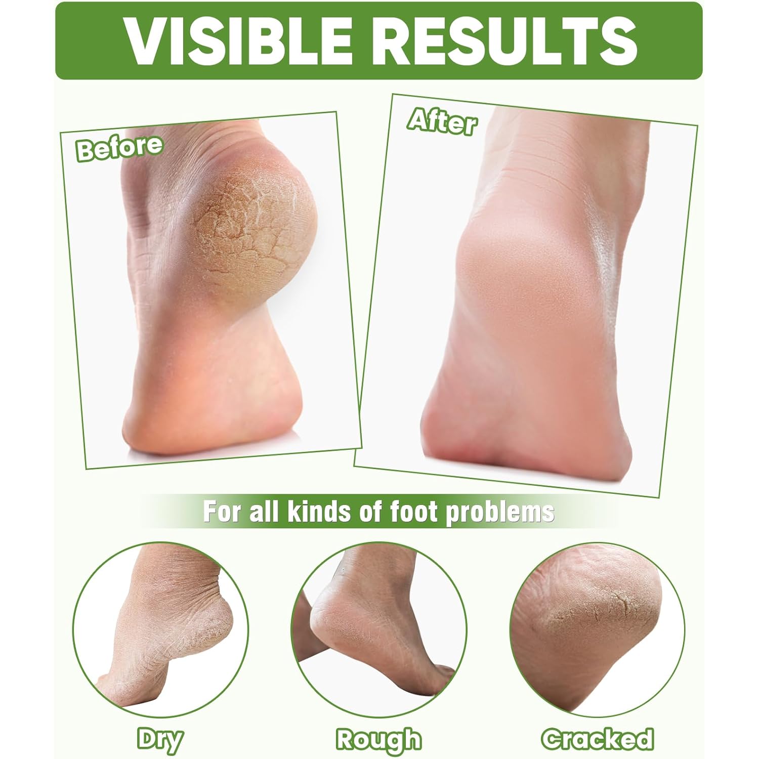 TEAWOO 8 Pairs Moisturizing Foot Masks with Aloe Vera Extract & Jojoba Oil, Intensely Hydrating Foot Mask for Dry Cracked Feet, Moisturizing Socks for Cracked Heel Treatment