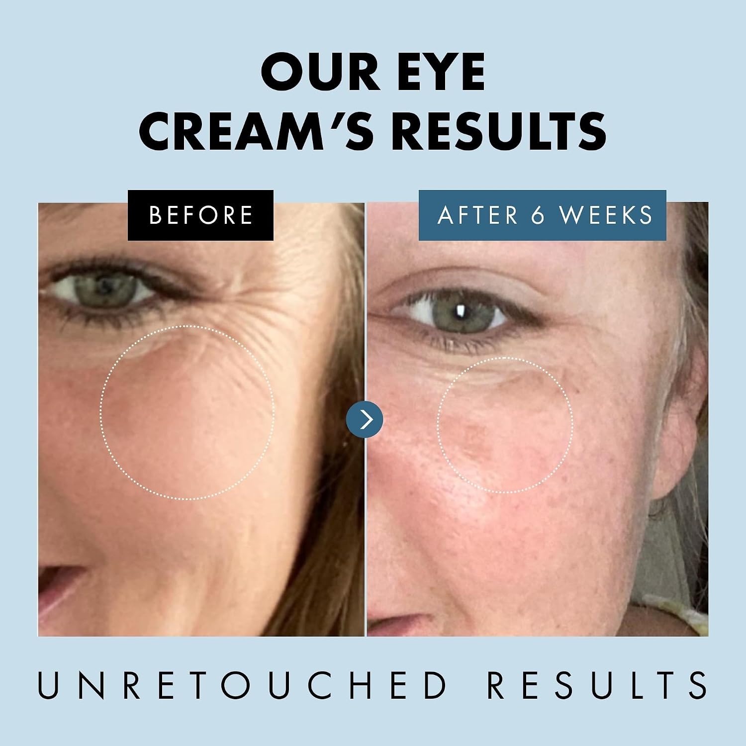 Eclat Skincare Under Eye Cream For Dark Circles & Puffiness – Anti Aging Formula For Wrinkles - Moisturizer For Fine Lines, Crows Feet & Eye Bags – Hydrating Treatment For Firming & Smoothing - 30Ml
