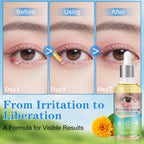 Stye Relief Serum & Eyelid Drops For Blepharitis & Chalazion | Natural Fast-Acting Formula For Lash Line & Under Eye | Gentle Cleansing Care 1.01 Fl Oz (Pack Of 1)