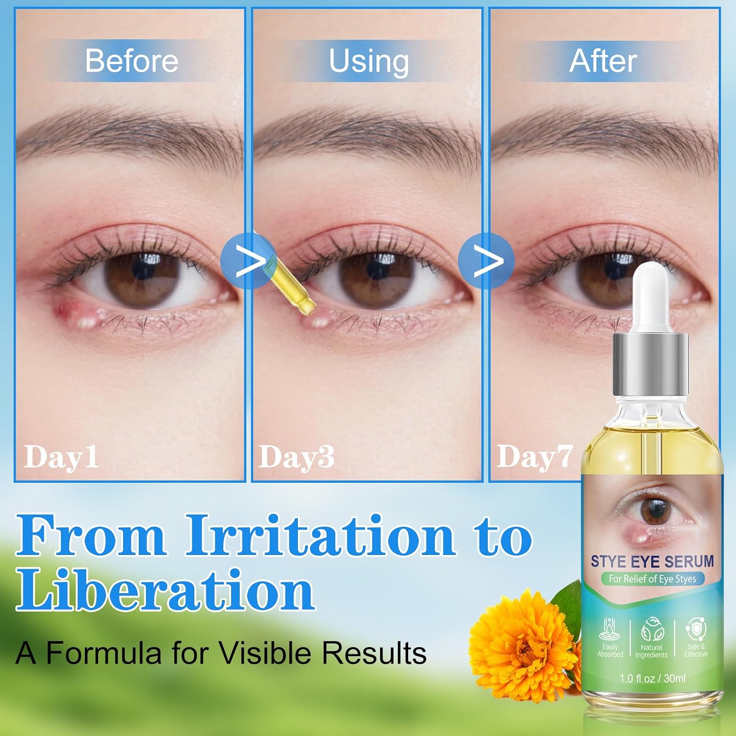 Stye Relief Serum & Eyelid Drops For Blepharitis & Chalazion | Natural Fast-Acting Formula For Lash Line & Under Eye | Gentle Cleansing Care 1.01 Fl Oz (Pack Of 1)