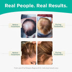 Shapiro MD Hair Growth Experts Leave-In Daily Foam, DHT Fighting Vegan Formula for Thinning Hair Developed by Dermatologists, Experience Healthier, Fuller & Thicker Looking Hair, 1 Month Supply