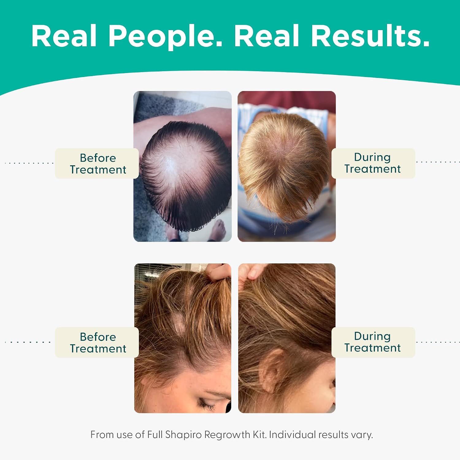 Shapiro Md Hair Growth Experts Vegan Hair Loss Shampoo For Thinning Hair | Experience Healthier, Fuller And Thicker Looking Hair (1 Month Supply)