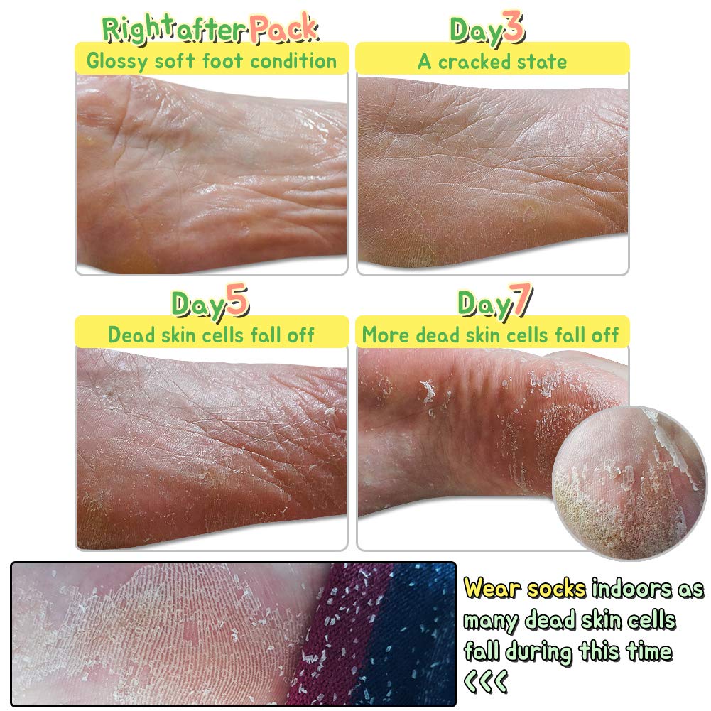 Elizavecca/Foot Peel /1 Foot Pack 2 Pairs Foot Mask - Boots for Exfoliating/foot pack review/foot pack before and after