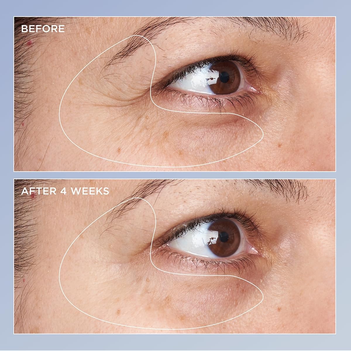Perricone Md High Potency Triple Retinol Renewal Eye Serum - Retinol Serum With Coq10 & Beta-Carotene - Visibly Reduces Crow’S Feet, Wrinkles, & Discoloration For A Firmer, Smoother Skin - 0.5 Fl Oz