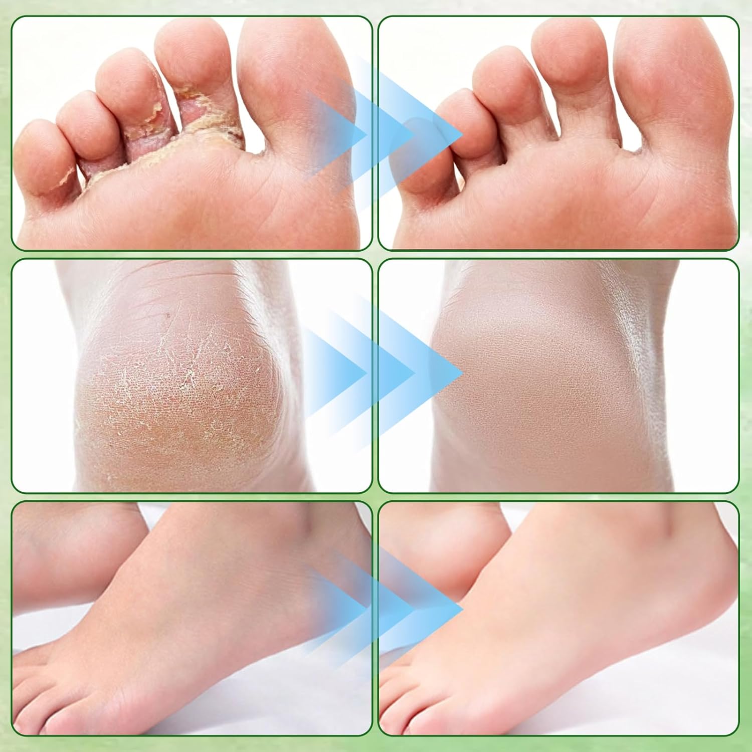 2Pcs Pure Tea Tree Oil Foot Cream with Vitamin E, Aloe Vera & Peppermint, Nourishing & Hydrating, for Dry Cracked Feet, Hands, Heels, Elbow, Nails, and Knees, Smooth Application-50g/1.764oz