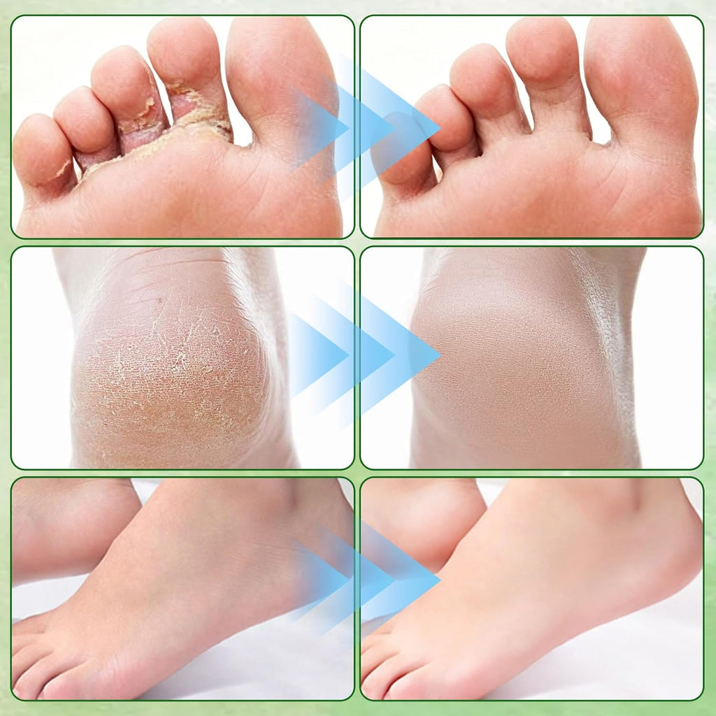 2Pcs Pure Tea Tree Oil Foot Cream with Vitamin E, Aloe Vera & Peppermint, Nourishing & Hydrating, for Dry Cracked Feet, Hands, Heels, Elbow, Nails, and Knees, Smooth Application-50g/1.764oz