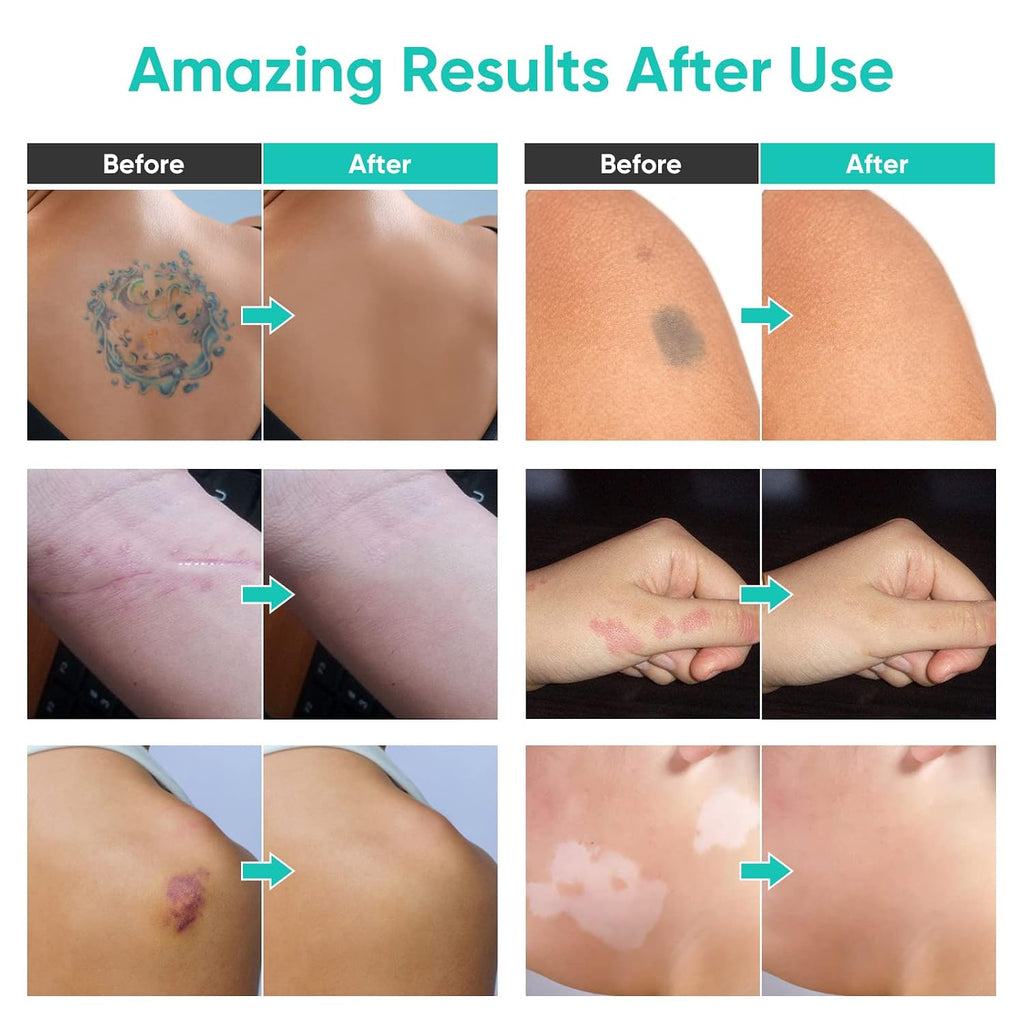 Tattoo Cover Up Makeup Waterproof, 2 Colors Professional Body Concealer Set, Long Lasting And Invisible Body Makeup Suitable For Vitiligo, Dark Spots, Scars