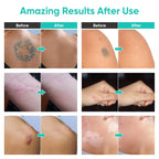 Tattoo Cover Up Makeup Waterproof, 2 Colors Professional Body Concealer Set, Long Lasting And Invisible Body Makeup Suitable For Vitiligo, Dark Spots, Scars
