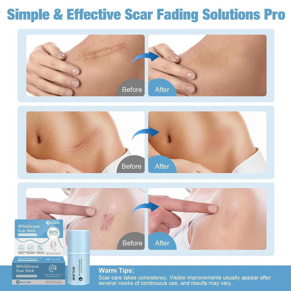 Silicone Scar Stick, 80% Silicone Stick For Face And Body. Silicone Stick For Removal Of Surgical,Old And Recent Scars And Stretch Marks - 7G