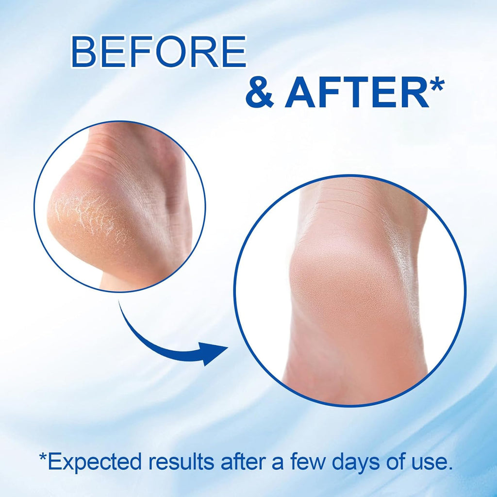 60% Urea Cream Stick with 2% Salicylic Acid, Maximum Strength Urea Foot Cream for Dry Cracked Heels, Callus Remover, Rapidly Softens the Hardest, Thickest Skin. Visible Smoothness in Days, Non-Greasy