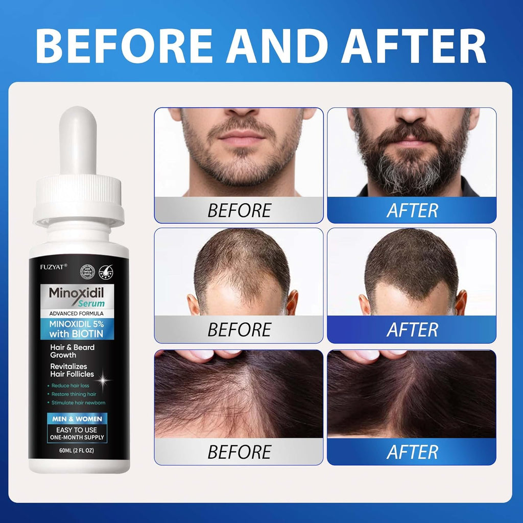 5% Minoxidil for Men, Minoxidil for Women Hair Growth Treatment, Beard Growth Serum, Biotin & Castor Oil Enriched,Strengthens Weak Roots, Repairs Thinning Hair (120ml)