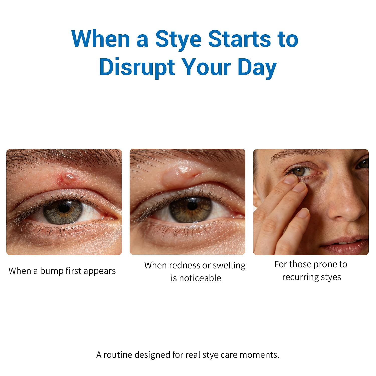Stye Eye Treatment 2 Kits-Stye Relief Rollerball Serum & 10 Pcs Eye Patches | For Styes, Chalazions And Blepharitis Treatment For Eyelids, Stye Eye Compress, Clear Eyes Redness Relief, Sleep Eye Mask