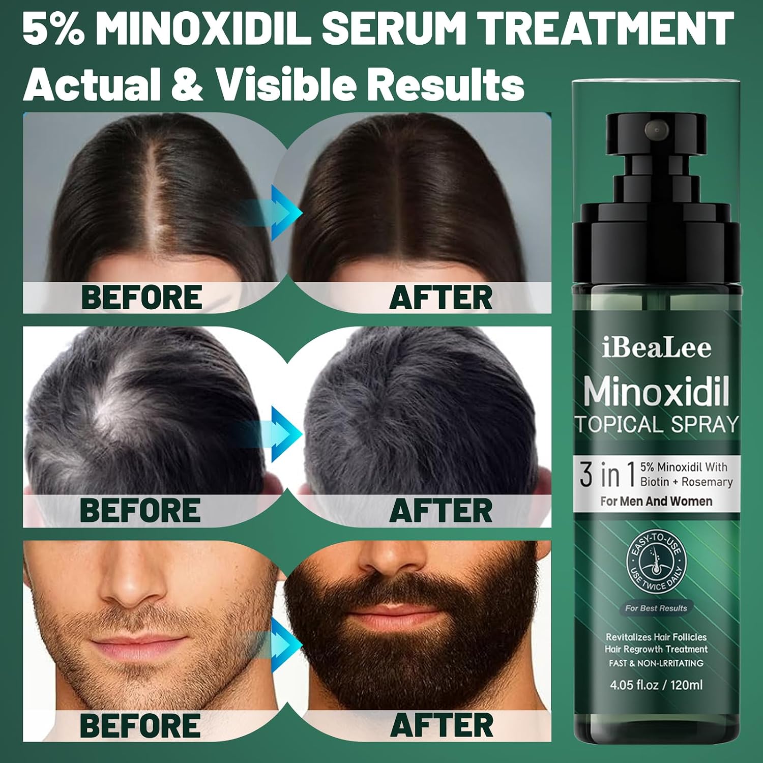 5% Minoxidil For Men And Women Hair Growth, Minoxidil Hair Growth Spray With Biotin & Rosemary, Extra Strength Hair Loss Treatment Serum For Thicker Hair & Beard Regrowth, 2 Bottles
