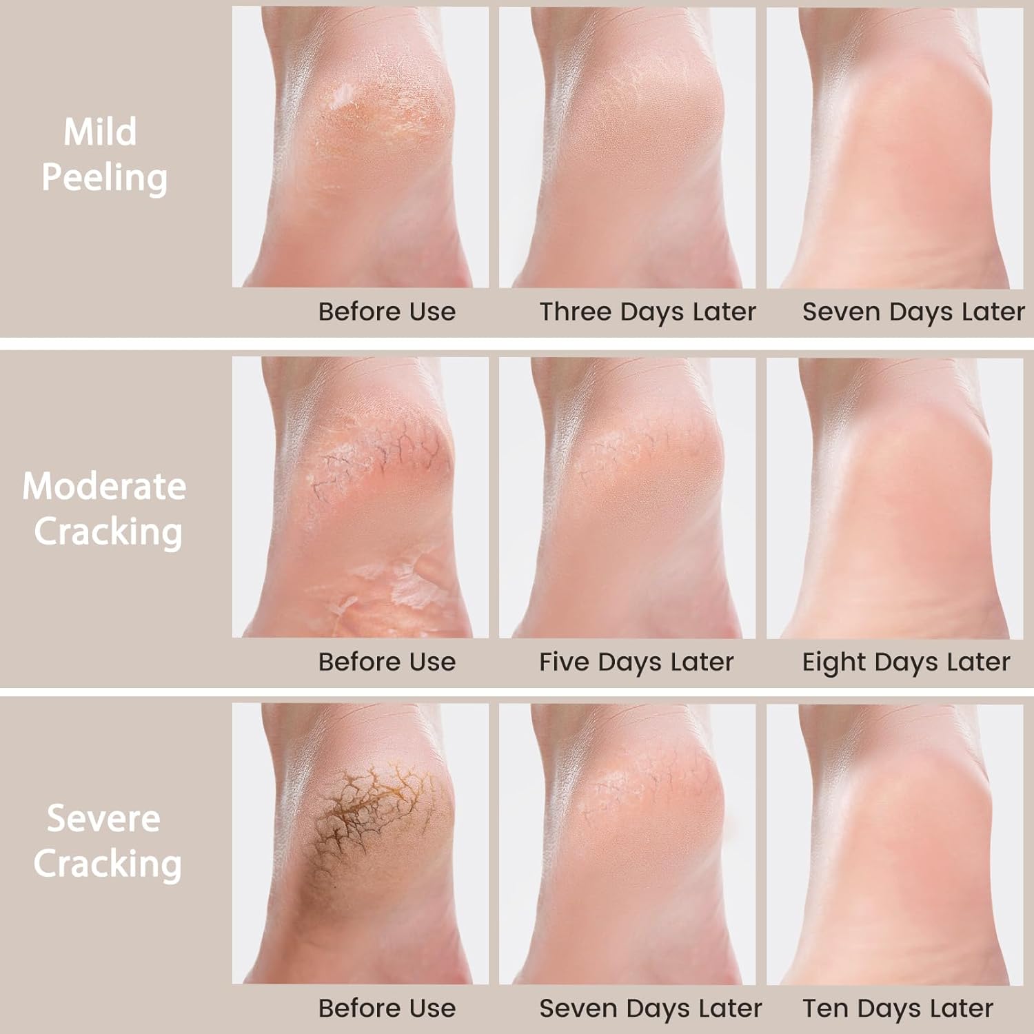 Urea Cream 40 Percent - Foot & Hand Cream for Dry, Cracked Heels, Feet, Knees, Elbows, and Hands - Maximum Strength Urea Lotion for Softening and Moisturizing