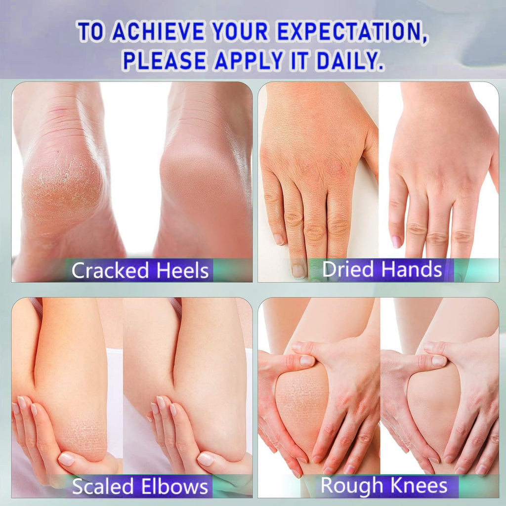 Urea Cream with 2% Salicylic Acid Foot Cream for Dry Cracked Heels, Heel Care Cream 5.29 Oz (Pack of 1)
