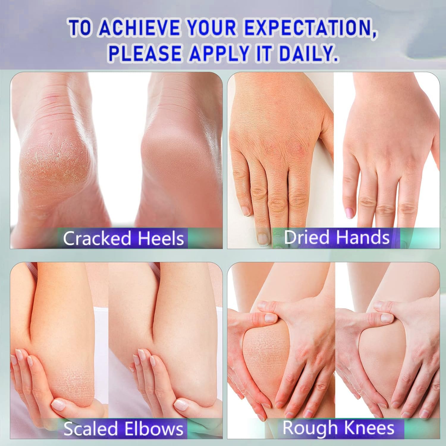 Urea Cream with 2% Salicylic Acid Foot Cream for Dry Cracked Heels, Heel Care Cream 5.29 Oz (Pack of 1)