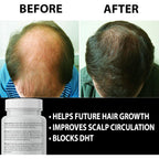 Finanutride Natural DHT Blocker & Hair Growth Capsules - Prevent Hair Loss, Stimulate Follicles, Proprietary Regrowth Treatment