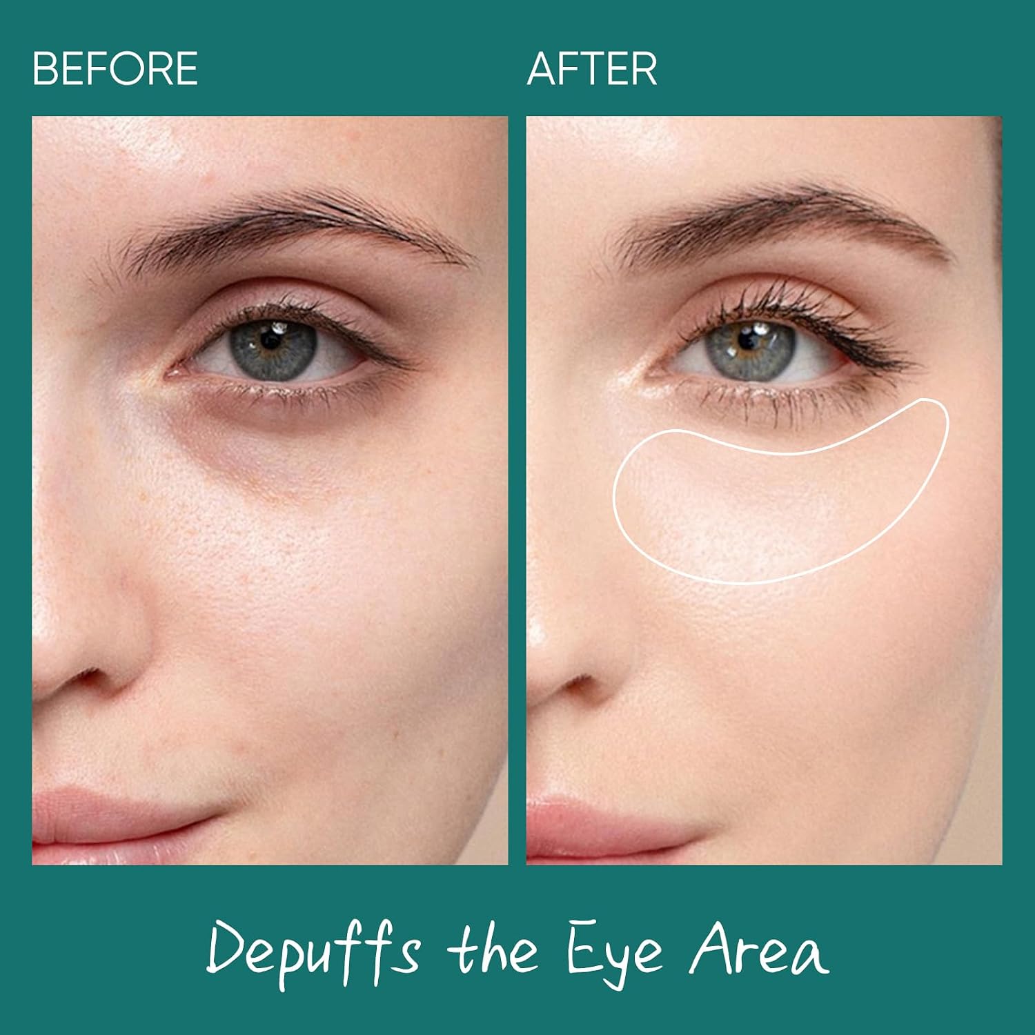 Salmon Dna Pdrn Eye Cream For Puffiness And Bags Under Eyes - With Caffeine & Hyaluronic Acid, Niacinamide For Dark Circle & Hydration