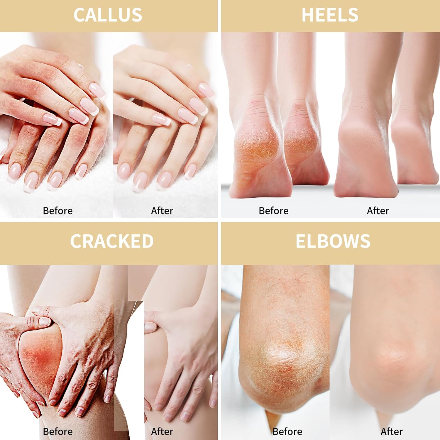 Urea Cream 50 Percent for Feet with Oat 5.29 oz || Foot & Hand Cream Maximum Strength with 2% Salicylic Acid, Tea Tree and Aloe Vera for Deep Moisturizing and Callus Removing (Upgraded Formula)