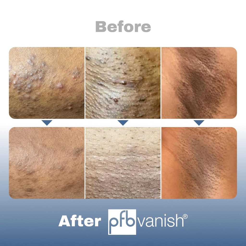 PFB Vanish Ultra with Chromabright & Shitake Mushroom, Triple Action Dark Spot Remover, Ingrown Hair & Razor Bump Stopper, Roll-On Skin Care Treatment, 93g – New Formula