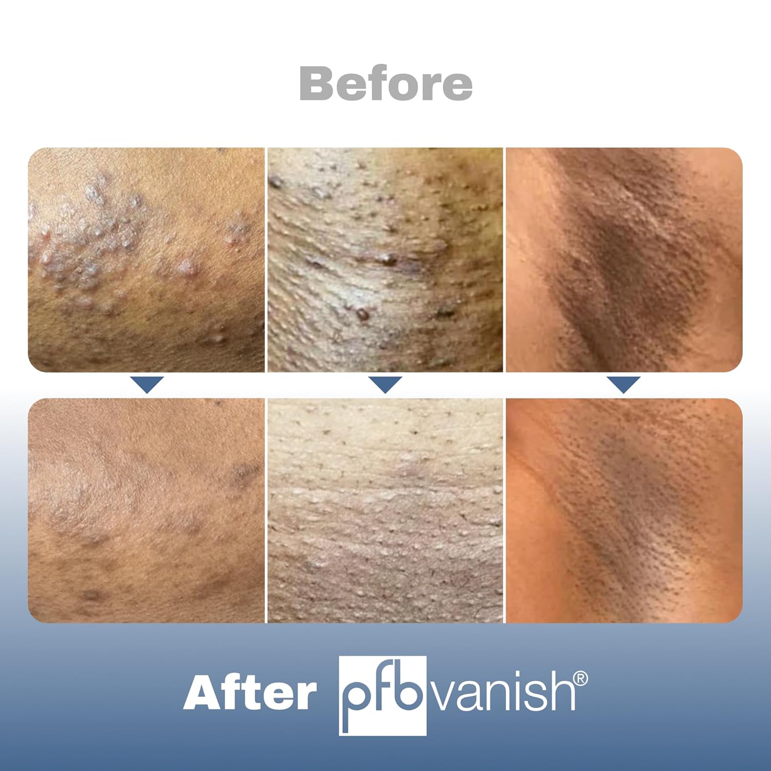 PFB Vanish Ultra with Chromabright & Shitake Mushroom, Triple Action Dark Spot Remover, Ingrown Hair & Razor Bump Stopper, Roll-On Skin Care Treatment, 93g – New Formula