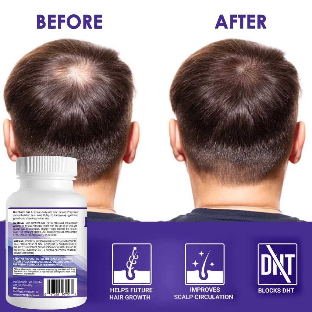 Propidren Dht Blocker & Hair Growth Pills To Stop Hair Loss And Regrow Hair | Prevents Hair Loss
