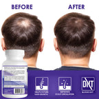 Propidren Dht Blocker & Hair Growth Pills To Stop Hair Loss And Regrow Hair | Prevents Hair Loss