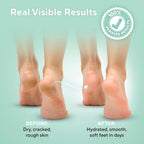 Lavinso Urea Cream 40 Percent for Feet with Maximum Strength - Foot Cream for Calluses and Dry Cracked Heels - Rough Skin Repair for Men and Women