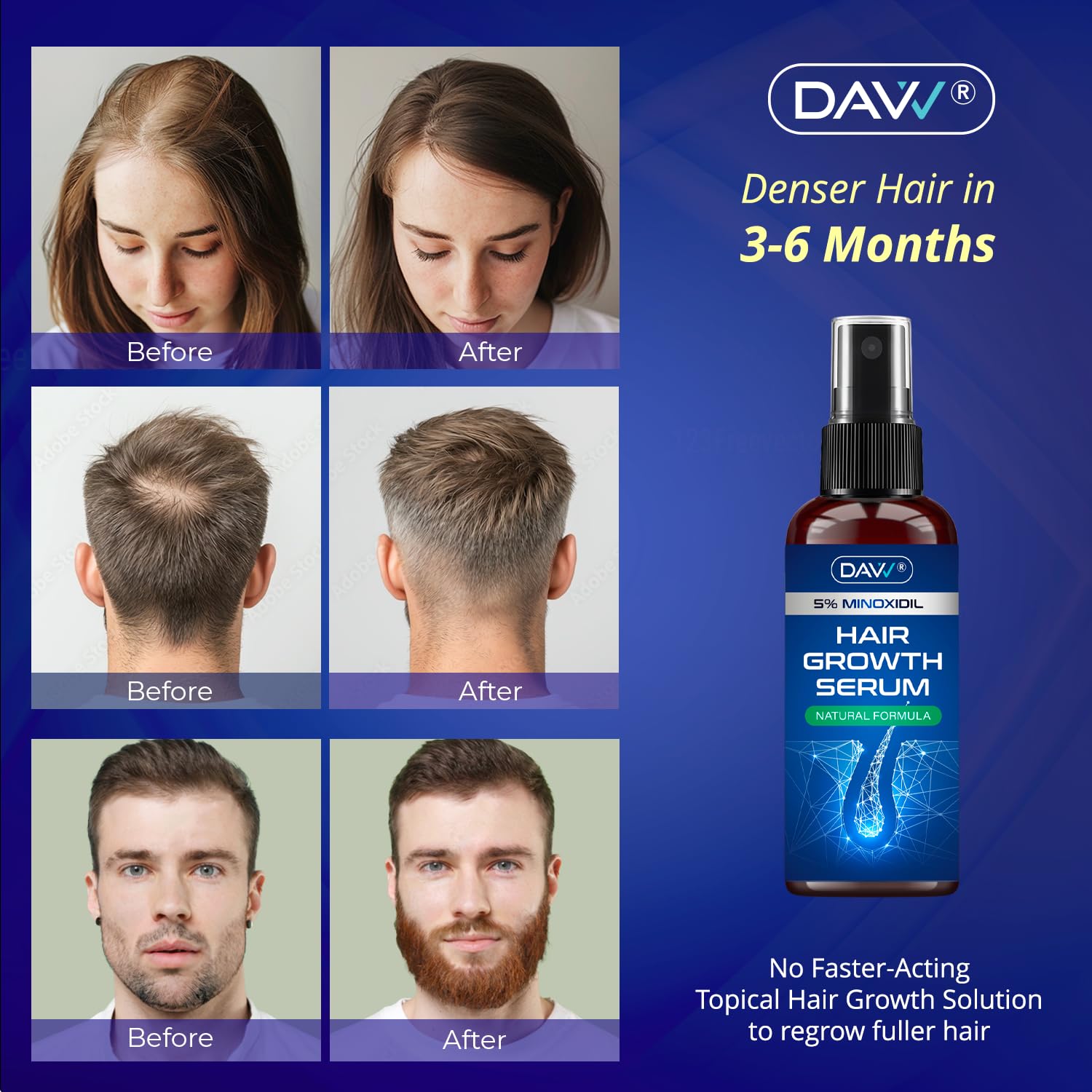5% Minoxidil for Women and Men: 2-Pack Minoxidil Hair Growth Products - Minoxidil for Men - Biotin Serum - Hair Growth Serum with Rosemary - Hair Loss Solution - Faster Stronger Thicker - 60ML Each