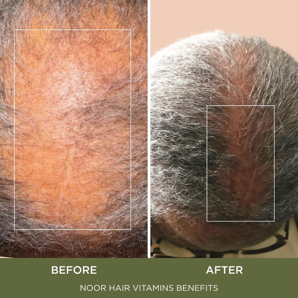 Noor Hair Healthy Hair Formula, Hair Growth Supplement Supporting Thick Hair And Fast Hair Regrowth. Vitamin C, B6, Zinc, Propietary Non-Gmo & Gluten Free Womens Hair Loss Vitamins - 30 Day Supply
