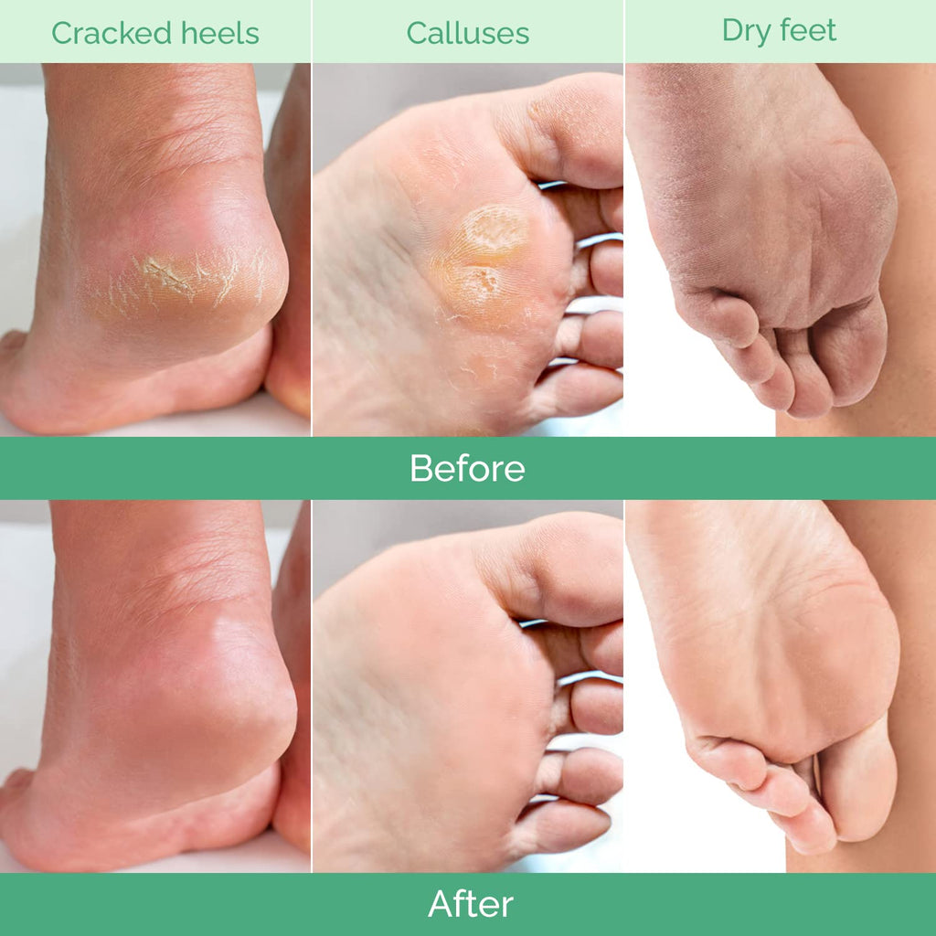 PLANTIFIQUE Foot Peeling Mask 2 Pack | Dermatologically Tested Repairs Heels & Removes Dry Dead Skin for Baby Soft Feet | Exfoliating Foot Peel Mask for Dry Cracked Feet | Peach